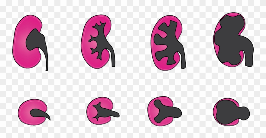 Acute Vs Chronic Hydronephrosis Clipart