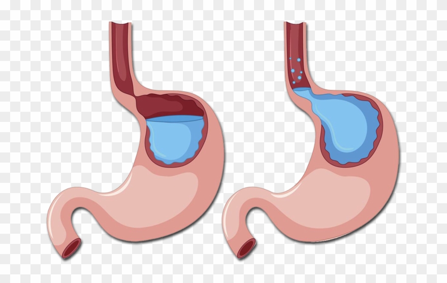 Doença Do Refluxo Gastroesofágico Clipart