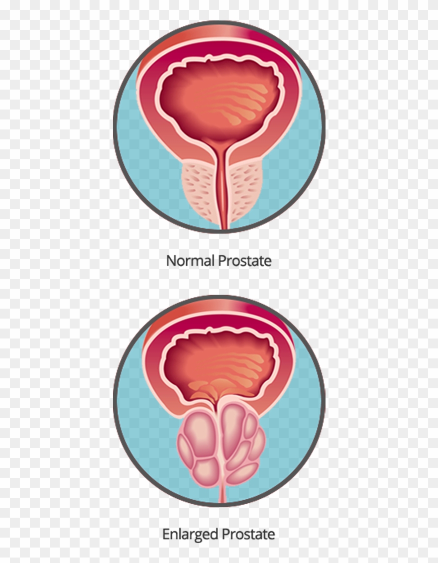 Prostate Cancer Can Be Found Early - Circle Clipart
