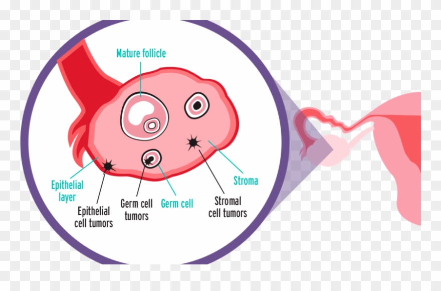Knowing These Ovarian Cancer Facts Could Save Your - Epithelial Ovarian Cancer Types Clipart