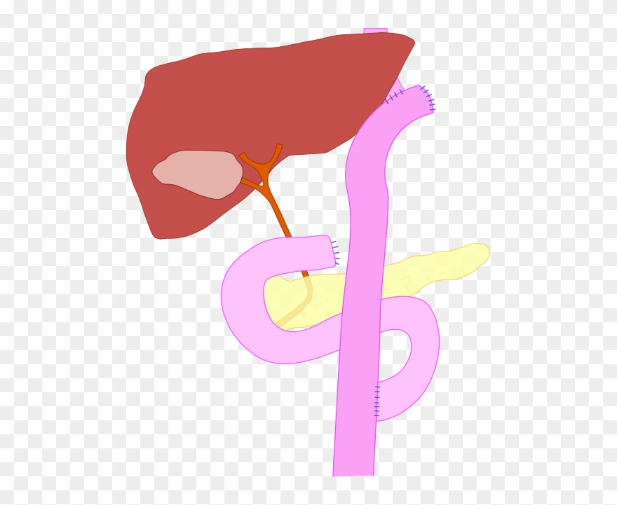 Total Gastrectomy With Roux En Y " - Roux En Y Gastrectomy Clipart