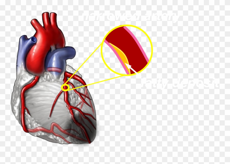 Moderate - Coronary Arteries Without Label Clipart