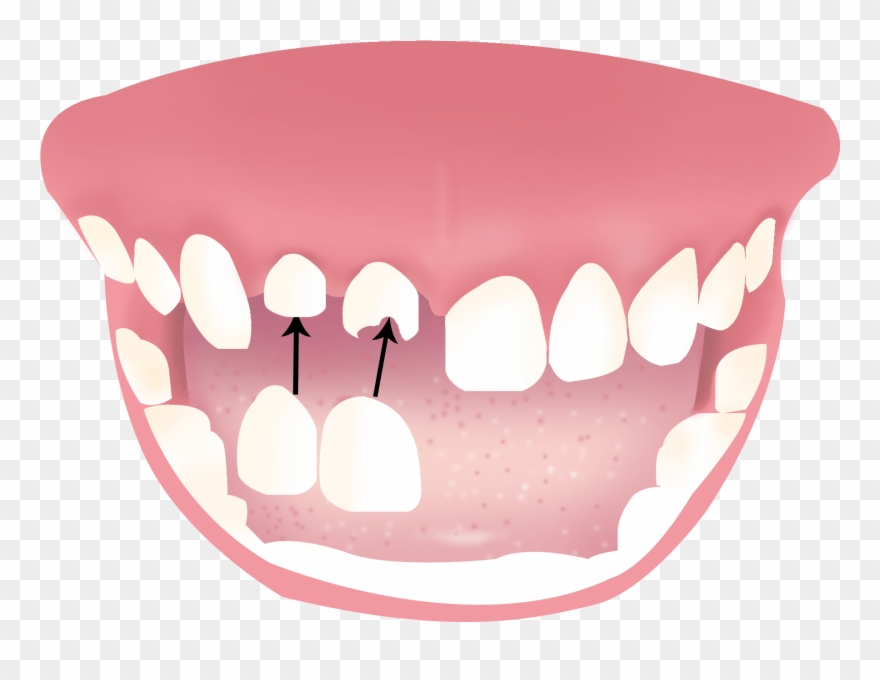 Generally A Crown Is Received In A Two-stage Process - Dentures Clipart