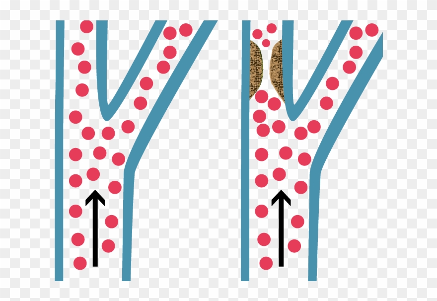 Illustration Of Carotid Artery Disease Clipart