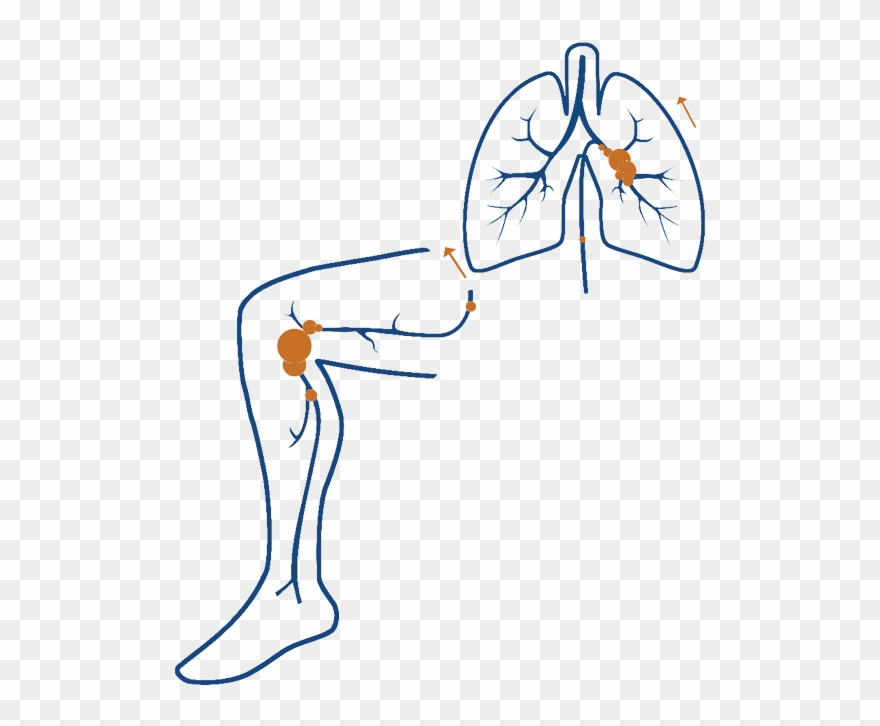 What Are Dvt And Pe Clipart
