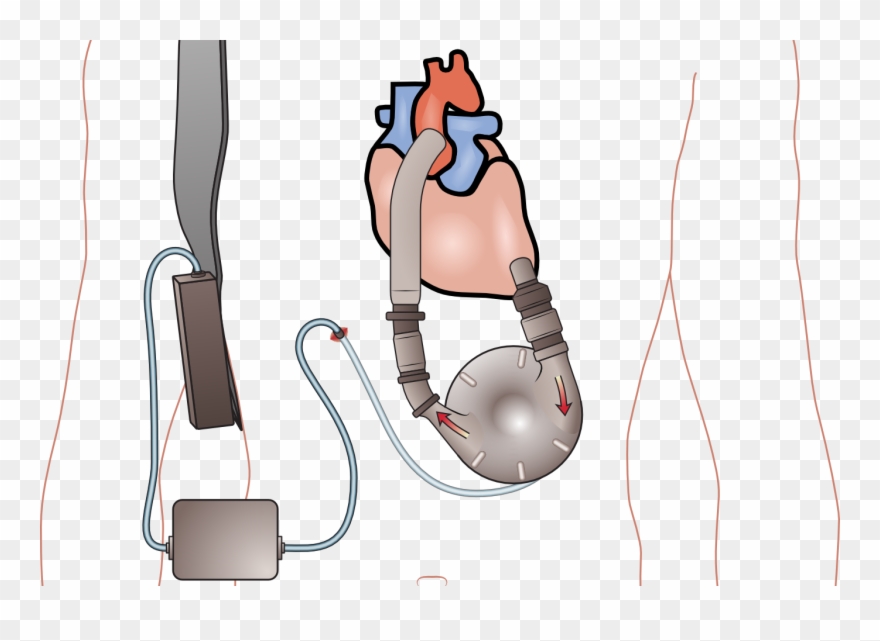 In The Current Issue Of The Journal Of Heart And Lung - Aparato Para El Corazon Clipart