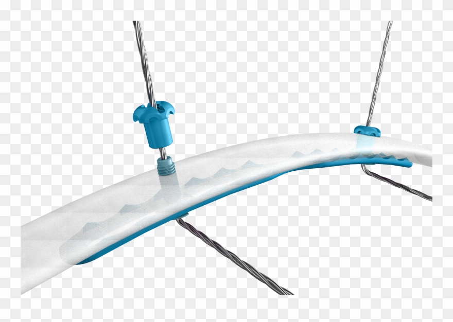 Minimally Invasive Alternative To Traditional Rib Fixation - Swing Clipart