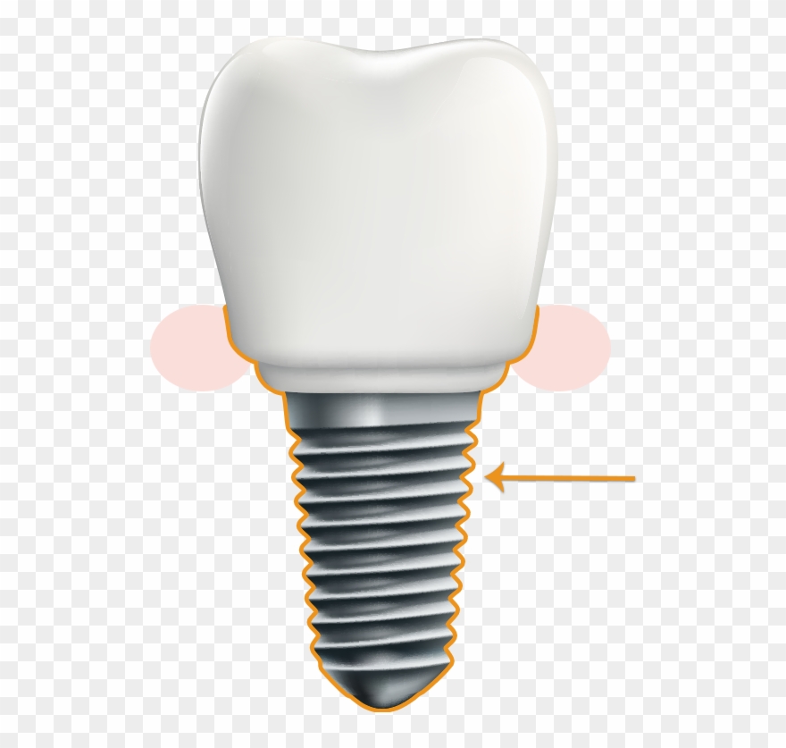 Periodontal Implant - Illustration Clipart