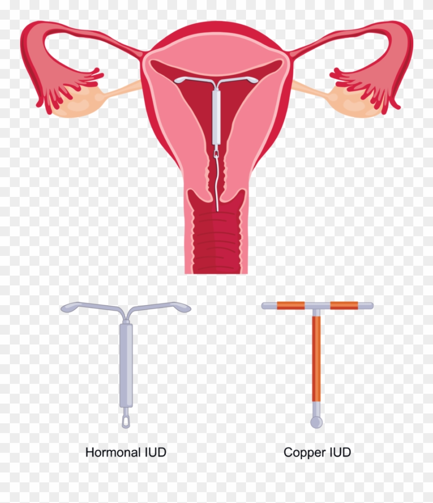 Iud Colorado Springs - Artificial Insemination In Humans Clipart