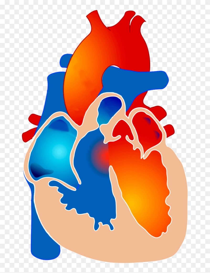 2000px Tetralogy Of Fallot It - Prove Tetralogy Of Fallot Clipart