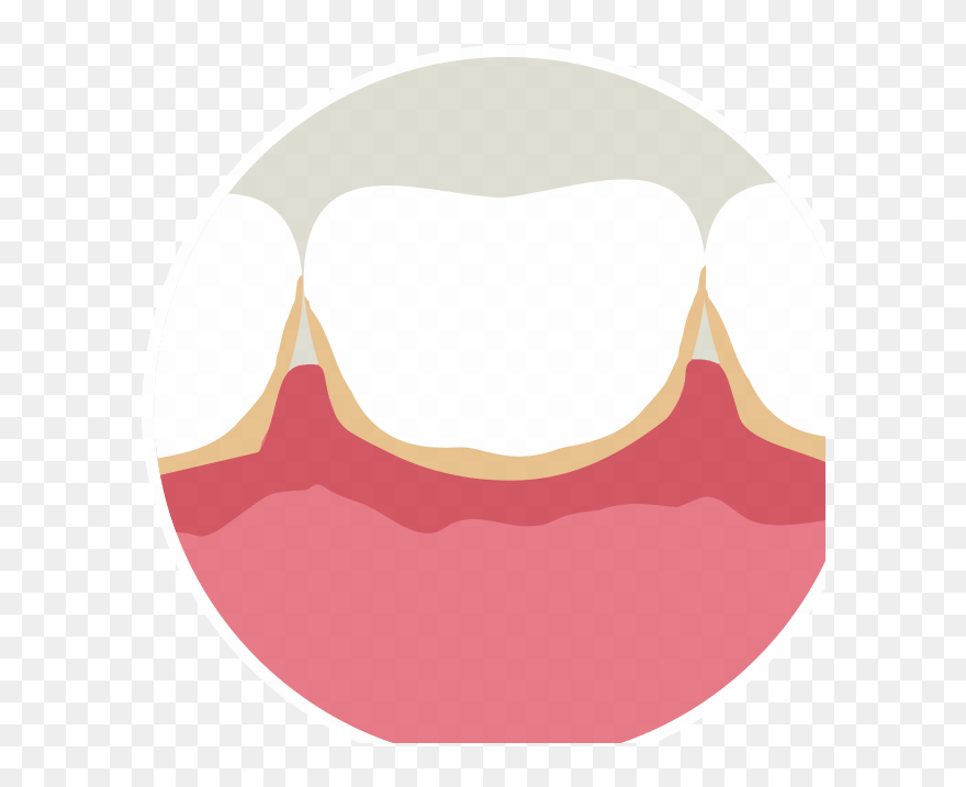 Bleeding Gums Illustration Clipart