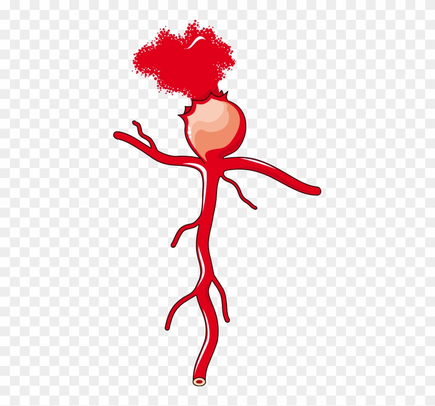 Download The Image - Intracranial Berry Aneurysm Clipart