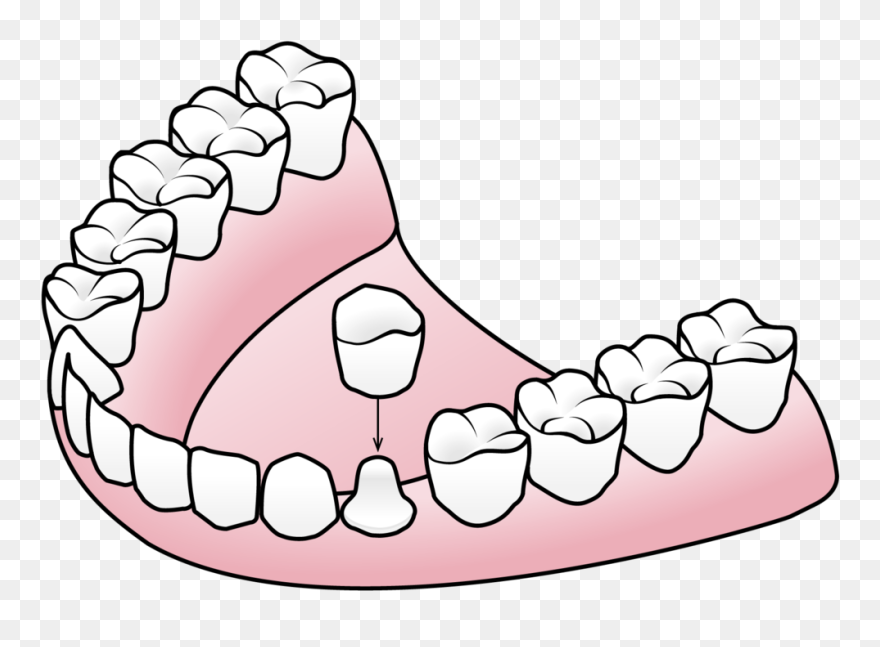 Tooth Clipart Crown Royalty Free Library Porcelain - Components Of A Denture - Png Download
