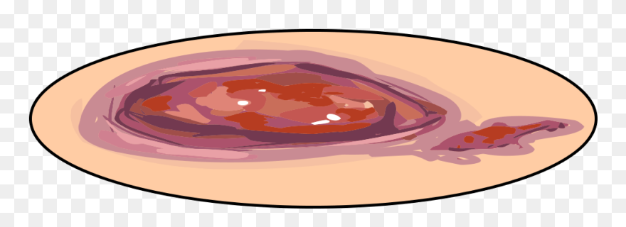 Illustration Of An Open Wound - Wound Maceration Clip Art - Png Download