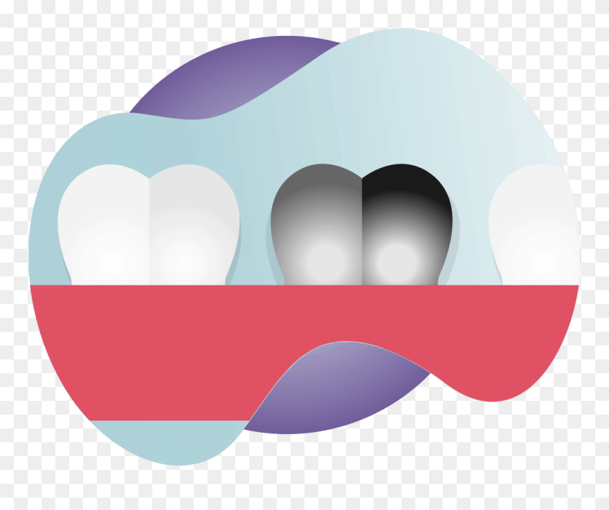 Stainless Steel Crown Covering A Primary Tooth - Graphic Design Clipart