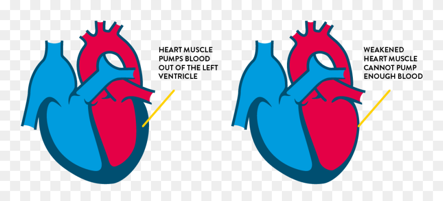 Congestive Heart Failure Drawing Clipart
