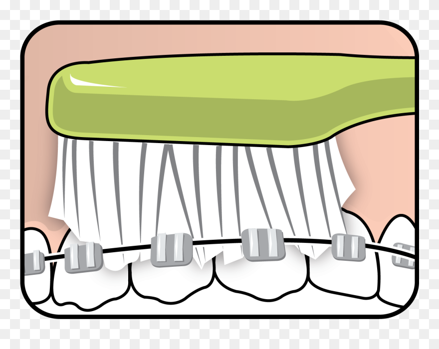 Tepe Supreme™ On Braces Clipart