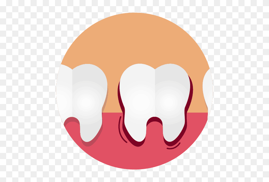 Swollen Gums Due To Gingivitis Graphic Clipart