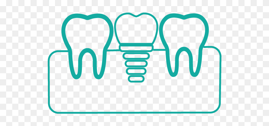 Single Tooth Implants Clipart