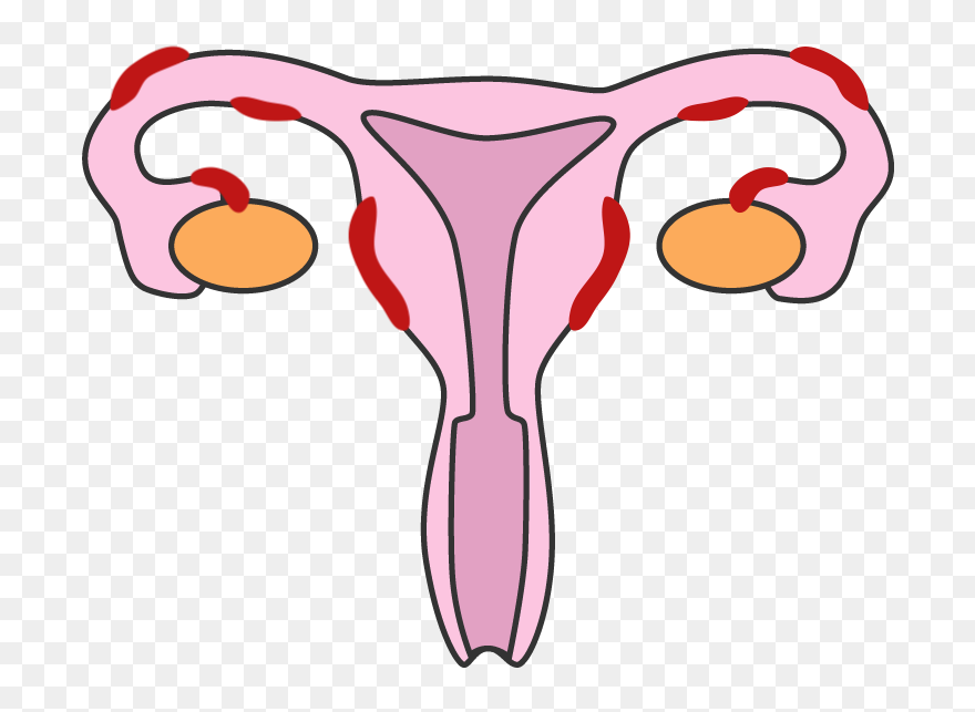 Endometriosis V2 Clipart