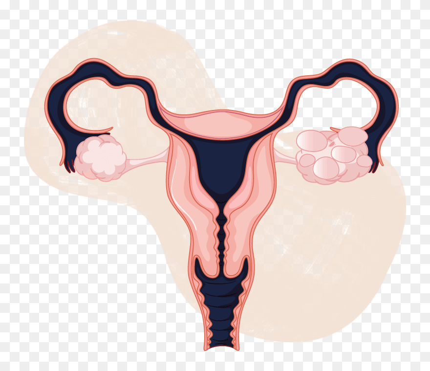 Pcos And Pregnancy - Female Reproductive System Cartoon Clipart