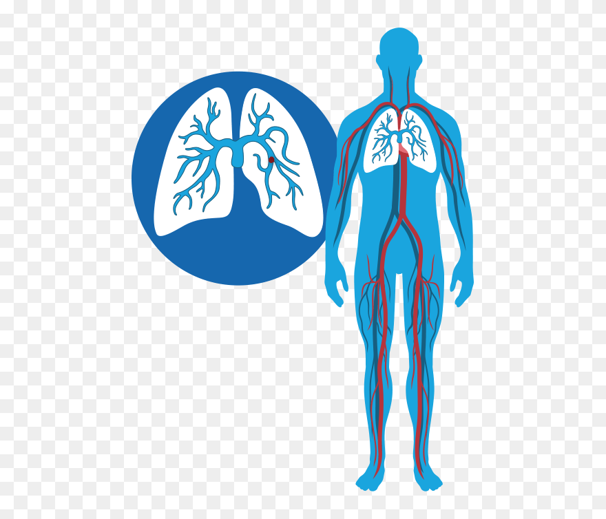 Dvt And Pe Diagram - Pulmonary Embolism And Dvt Clipart