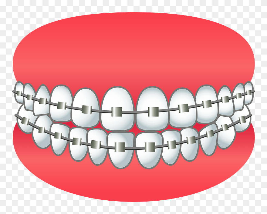 Dental Braces Clipart - Dental Braces - Png Download