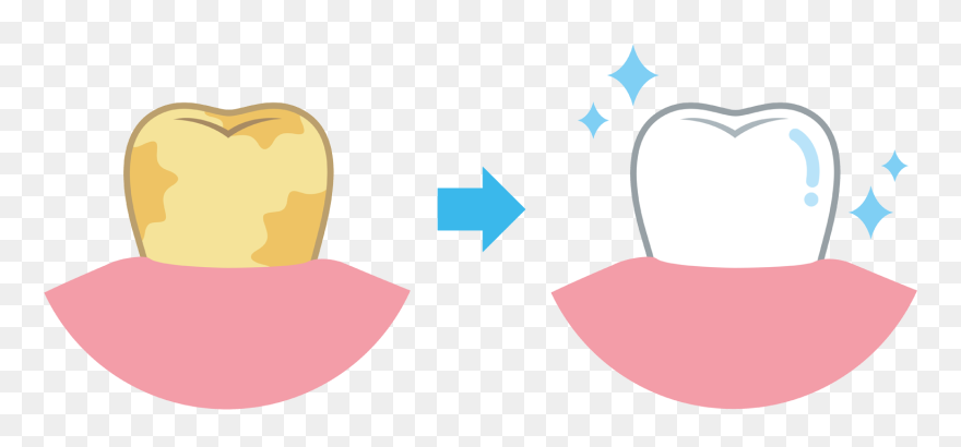 Transparent Toothache Clipart - Clean And Dirty Tooth - Png Download