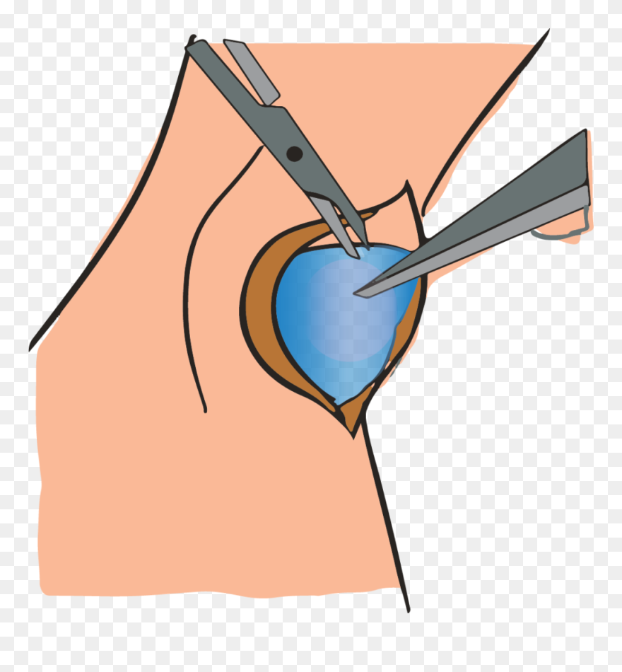 Removing Ganglion Cyst Through Surgery Clipart