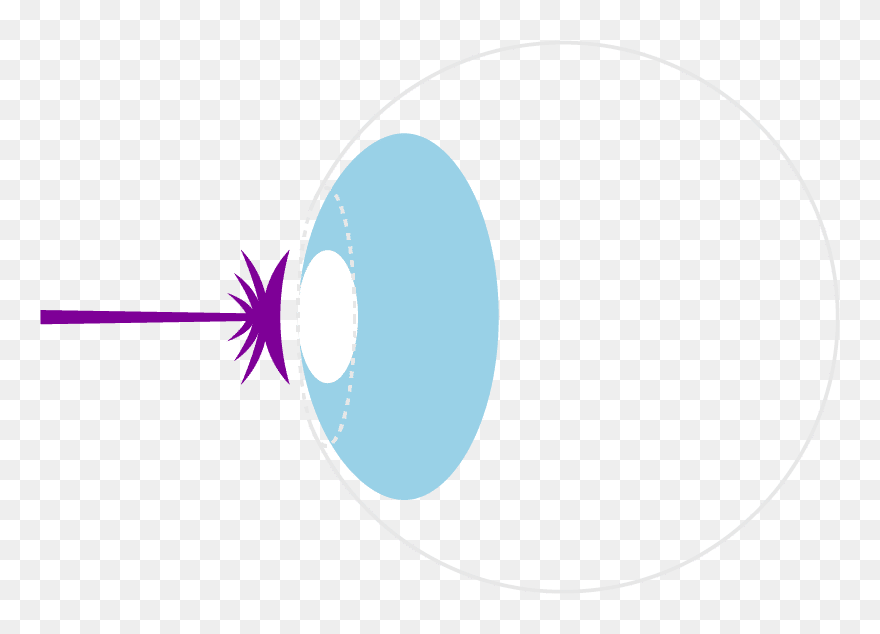 Transparent Laser Eye Surgery Clipart - Circle - Png Download