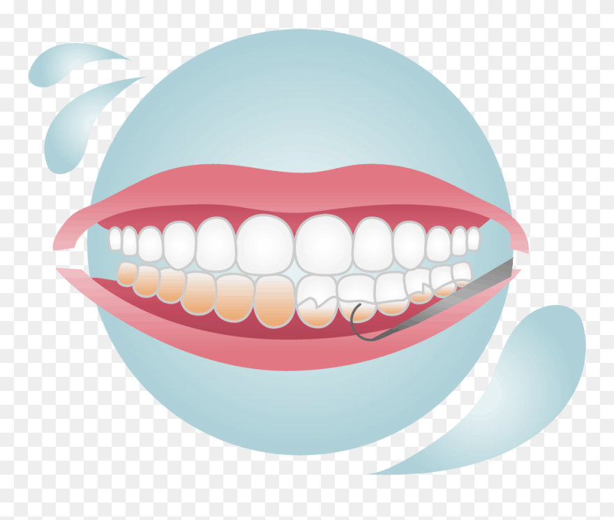 Removing Plaque And Tartar Stuck Above And Below The Clipart