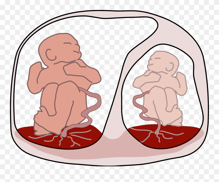 Twin To Twin Transfusion Syndrome Clipart