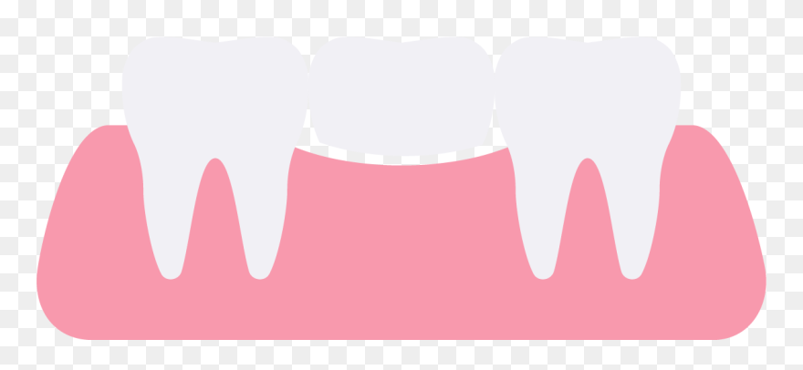 Dental Bridge Clipart