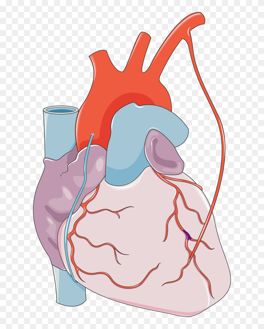 Coronary Heart Disease Bypass Clipart