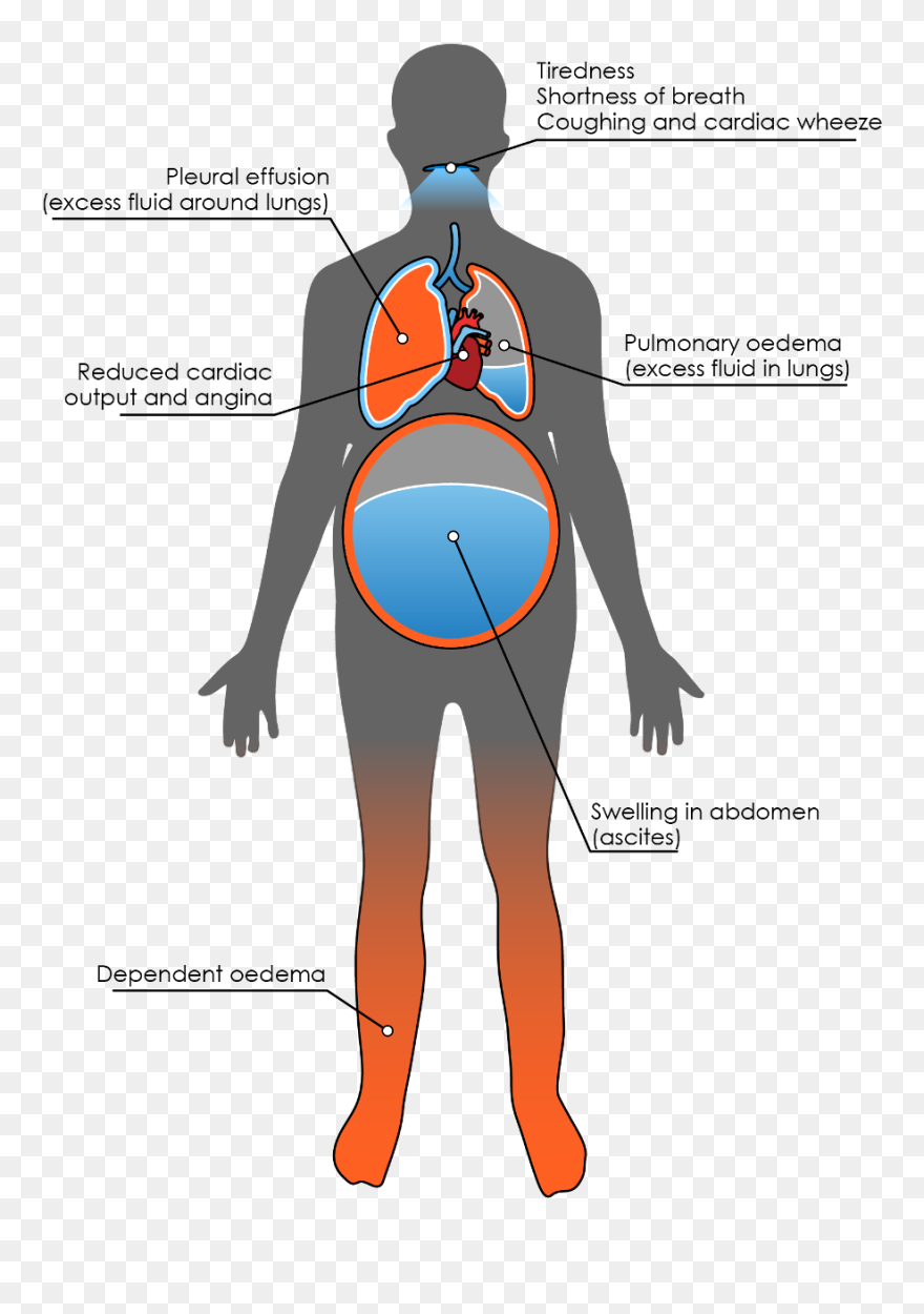 Transparent Shortness Of Breath Clipart - Heart Failure Edema - Png Download