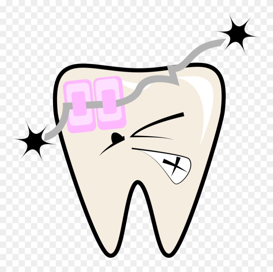 Braces-retainers Clipart