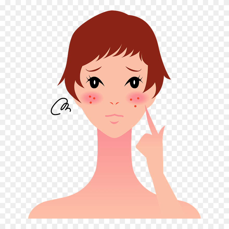 Woman Girl Skin Diseases Clipart - Acne - Png Download