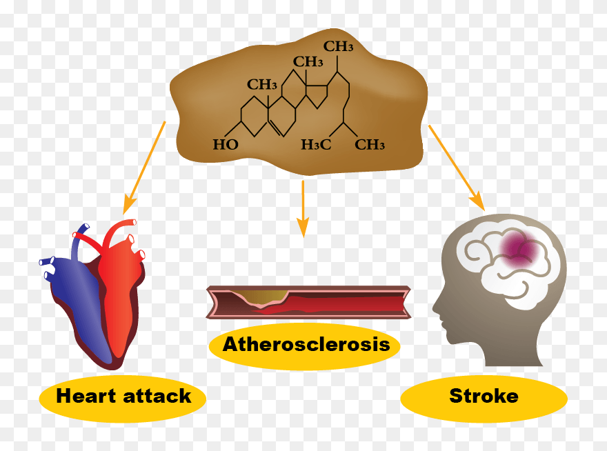 Stroke And Atherosclerosis Clipart