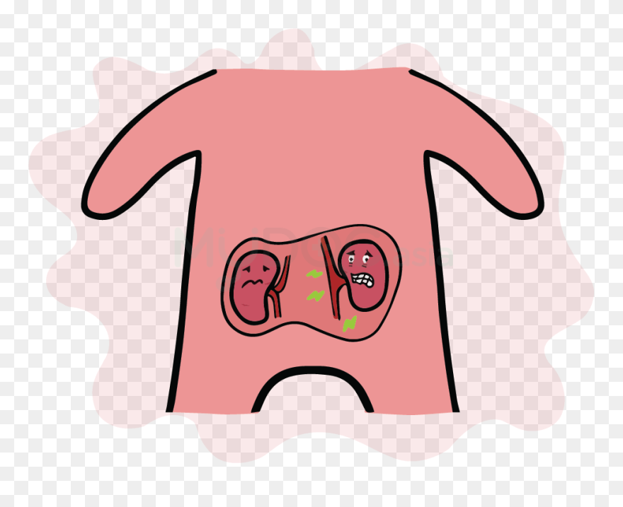 Juliet Station Diabetic Kidney - Cartoon Clipart