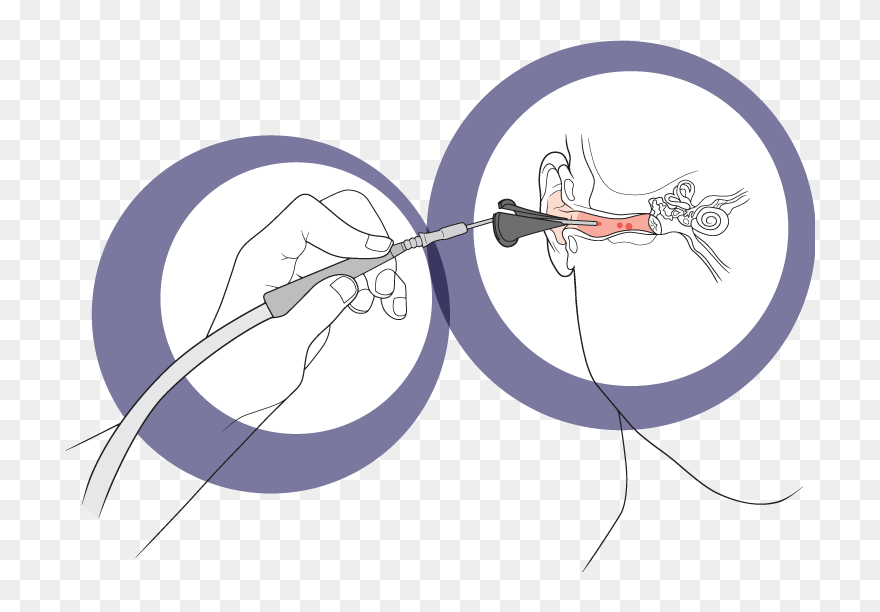 Ear Micro Suction Diagram Clipart