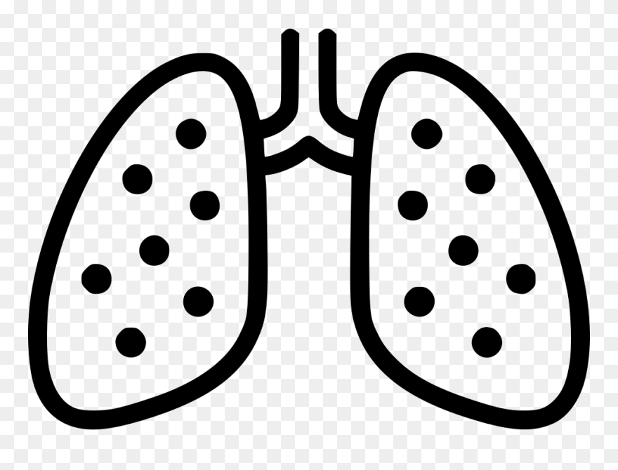 Chest X Ray Anatomy - Tuberculosis Clipart