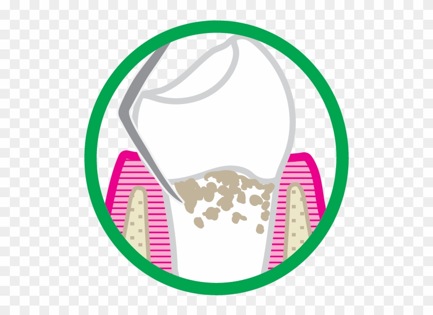 Scaling And Root Planing Is Usually Performed With Clipart