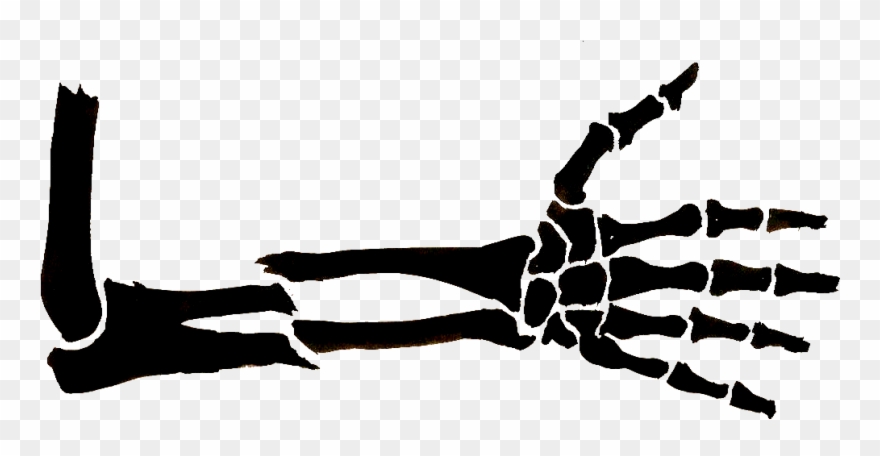 Broken Arm - Broken Arm Drawing Clipart