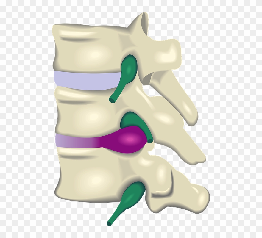 Disc Injury Herniation, Bulge, Protrusion Understanding - Protusiones Discales Clipart