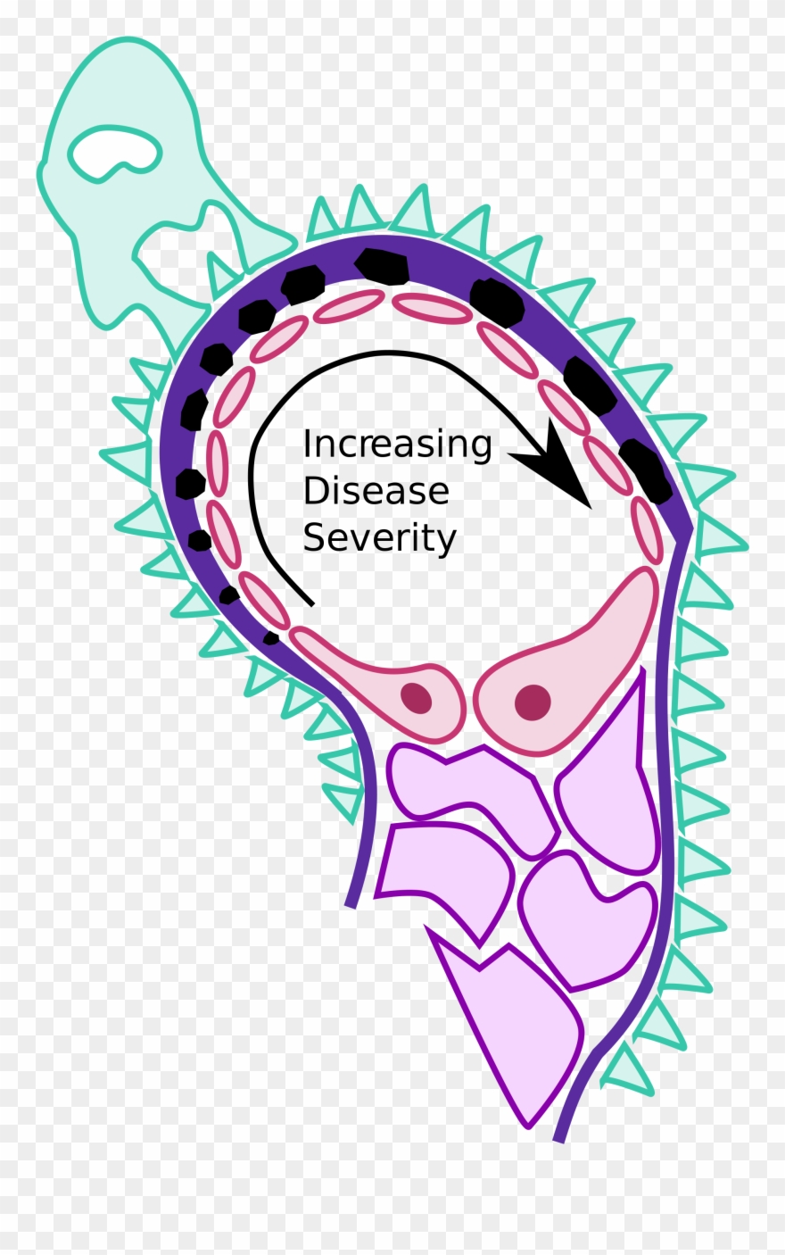 File Membranous Nephropathy Pathology Diagram Svg Wikimedia - Membranous Glomerulonephritis Spike And Dome Clipart