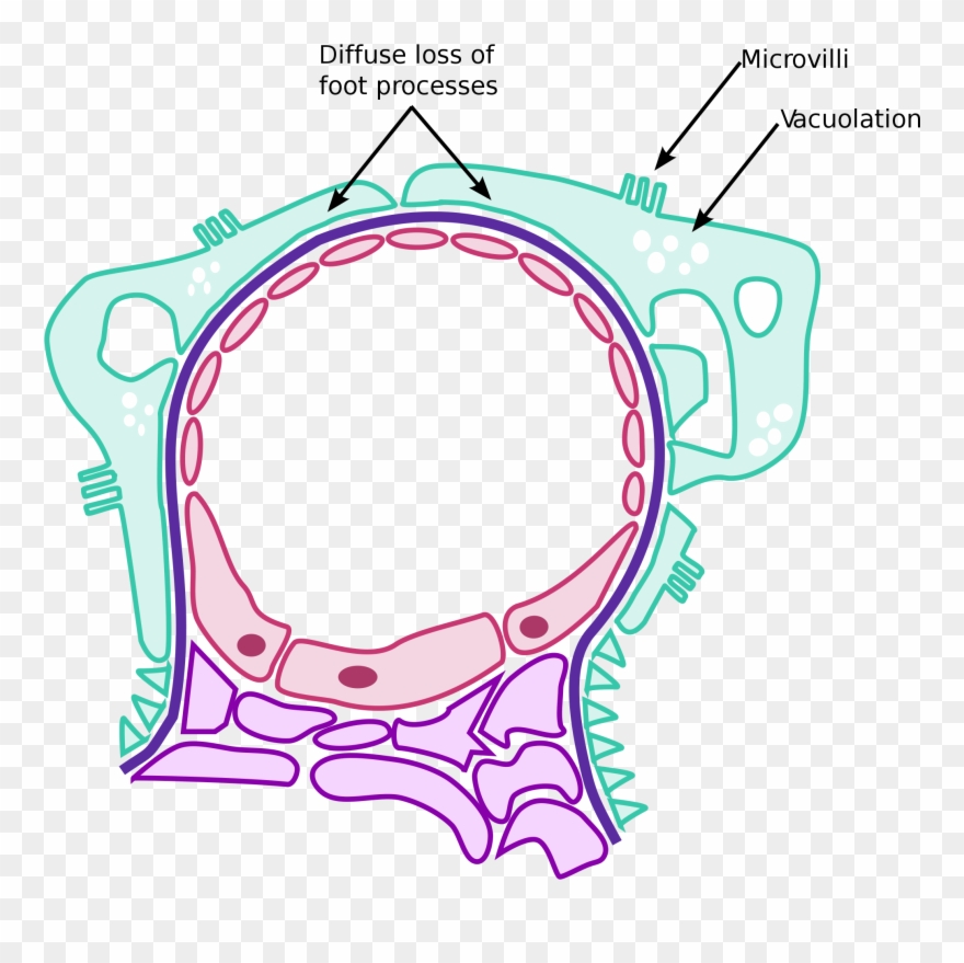 File Minimal Change Disease Pathology Diagram Svg - Minimal Change Disease Foot Process Clipart