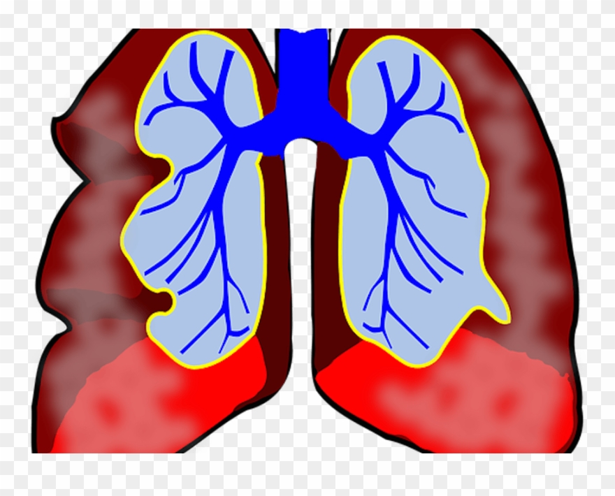 Allergic Asthma Signs Symptoms And Treatments Check - Clipart Lung Cancer Png Transparent Png