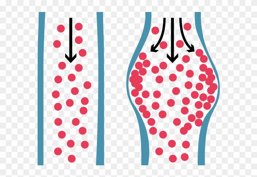 Carotid Artery Disease - Aortic Aneurysm Clipart