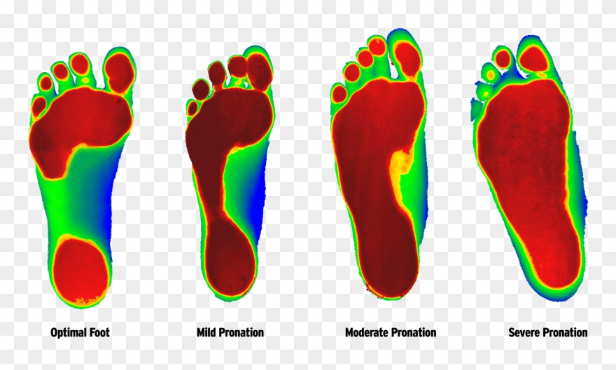 Foot Ranging From Least Severe To Most According To - Custom Orthotics Clipart
