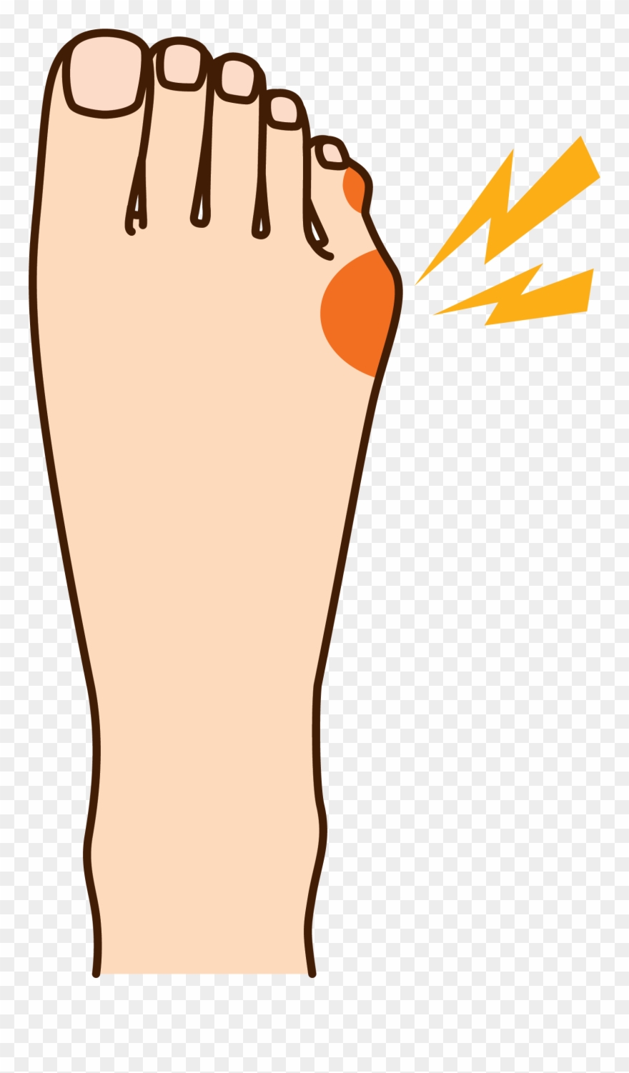 How To Relieve Your Tailor's Bunion Pain - Pinky Toe Bump Clipart